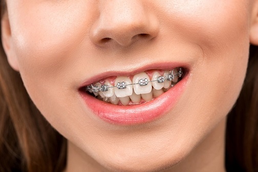 braces cost in delhi 